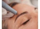 Best service for Skin needling in Holden Hill