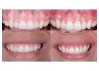 Dental Implants Fairless Hills PA