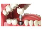 Dental Implants in Geneva