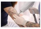 Best service for Tattoo Removal in Bayview Glen