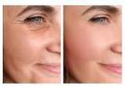 Best treatment for Anti Aging in Shellharbour