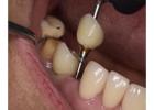 Full Mouth Dental Implants in Mexico with Teeth Savers