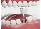 Siiodent Implants – Excellence in Dental Implant Solutions