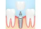 Siiodent Implants: Your Trusted Source for Bulk Dental Implants