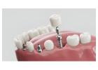 Top Dental Implant OEM Supplier in the USA | Siiodent Implants