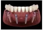 All-on-4 Dental Implants in Tijuana, Mexico – Affordable, Life-Changing Results!