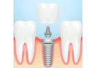 High-Quality Multi-Unit Abutment for Hex Implant Angled | Siiodent Implants