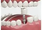 Siiodent Implants – Precision Multi-Unit Abutment for Hex Implant Straight