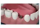 Siiodent Implants: Excellence in Dental Implant Manufacturing