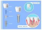 Siiodent Implants: SSI Conical Straight Implant 6° Taper