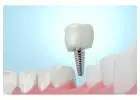 Trusted & Innovative: Siiodent Implants, the Leading Dental Implant Manufacturer