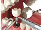 Enhance Implant Stability with HRI Angled Hex Abutment | Siiodent Implants