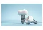 Choose Siiodent Implants for Reliable Basal SH Implants