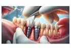 Reliable Abutment for Conical Micro Implant Straight Angled