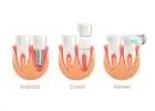 Get a Perfect Smile with Same-Day Crowns in Las Vegas!