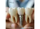 Top Quality Dental Implant OEM Suppliers in Guatemala