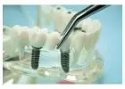 Find Abutment for Conical Micro Implant Straight Angled Fit