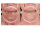 Laser Treatment For Wrinkles Daytona Beach