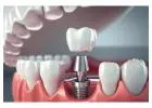 Get Permanent Dental Implants in Mumbai Today