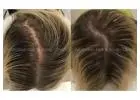 Practical Solutions for Female Hair Loss in Melbourne