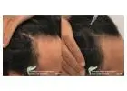 Unlock the Power of Science-Backed Hair Loss Treatment