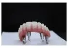Dental implants Tijuana offers natural-looking and durable teeth replacements
