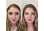 Best Facial Balancing in London