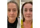 Best Botox treatment in Essendon