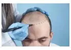 Hair Transplant in Islamabad