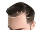 Exosomes for Hair Loss in Islamabad
