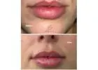 Best Service For Lip Fillers in CityPlace