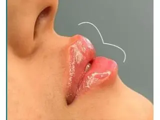 Best Lip Filler Injection clinic in St Albans Best Lip Filler Injection clinic in St Albans