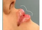 Best Lip Filler Injection clinic in St Albans