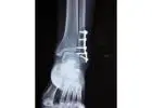 Expert Orthopaedic Care & Joint Replacement by Leading Orthopaedic Doctors in Indore