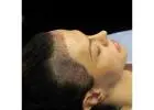 FUE Hair Transplant in Islamabad