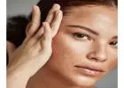 Melasma Treatment in Islamabad