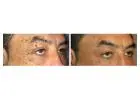 Skin Tags on Eyelids Removal – Gentle and Safe Care at London Dermatology Clinics