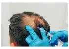 Best Hair Loss Treatment in Kampong Glam