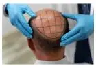 Hair Transplant in Islamabad