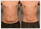 Liposuction in Islamabad