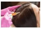PRP hair treatment in Islamabad