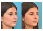 Best Clinic for Rhinoplasty in Islamabad