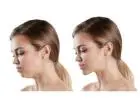 Jaw Surgery in Islamabad to Improve Jaw Stability