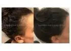 Female Hair Loss Support with Personal Care Focus
