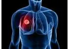 Lung Cancer Wallan