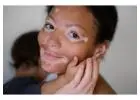 Natural and Medical Vitiligo Treatment in Islamabad