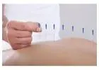 Best Acupuncture Therapist in Paddington