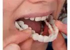 Best Clip On Veneers in Drimnagh