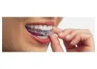 Clear Aligners Treatment in Thane - Agrawal Dental Clinics
