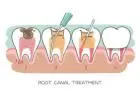 Best Root Canal Treatment in India